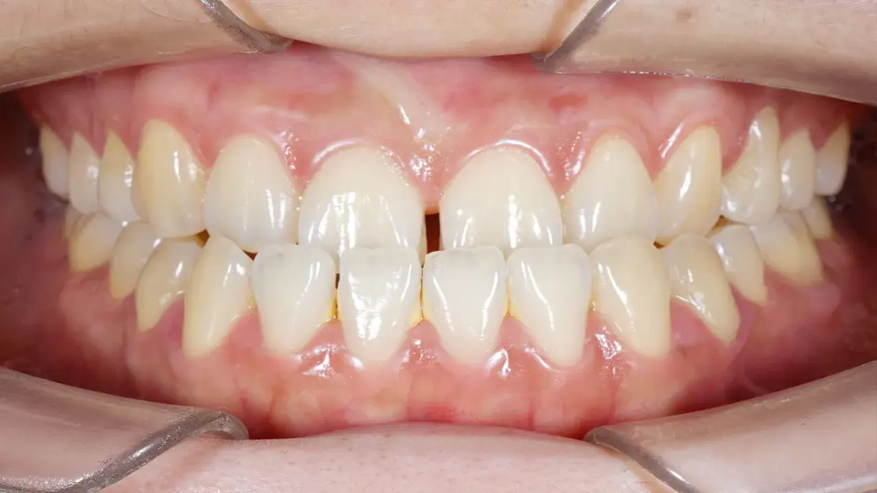 Denti superiori e inferiori di un adulto con un evidente morso incrociato. Si nota uno spazio tra gli incisivi superiori.
