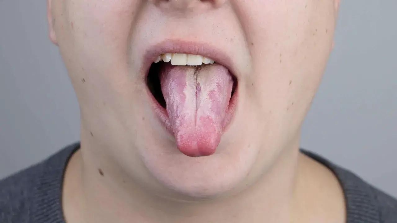 Lingua strana dopo antibiotico, con patina bianca e striature rosate.