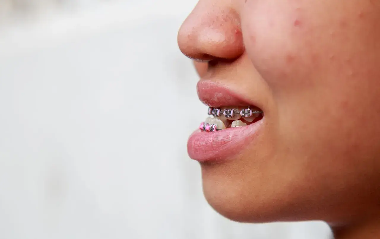 Primo piano di una bocca con apparecchio ortodontico, la **mandibola in avanti** per mostrare i denti allineati.