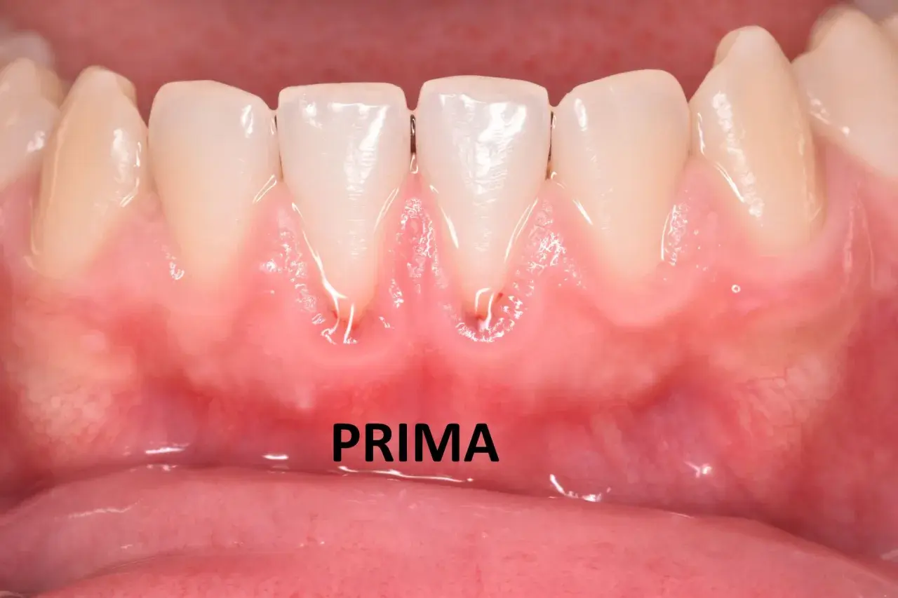 Gengive arrossate e gonfie, con segni di infiammazione, suggeriscono una stomatite gengivale. La parola "PRIMA" indica la situazione iniziale.