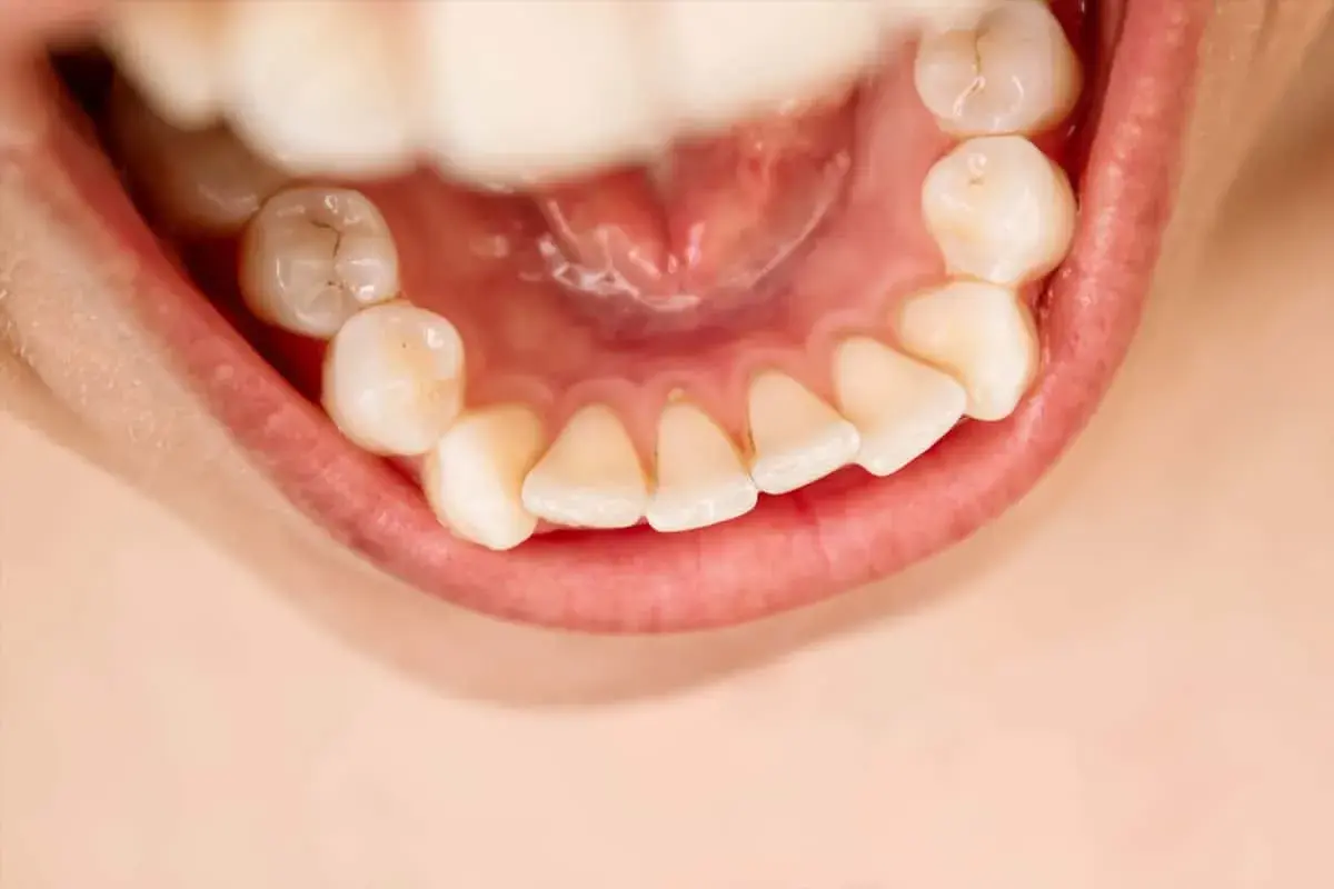 Denti ingialliti e con accumuli di tartaro, un rischio che fa cadere i denti.