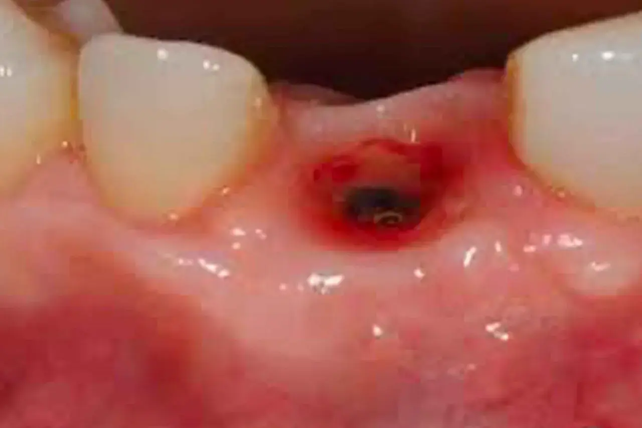 Cavità gengivale infiammata, forse un'alveolite, che mostra segni di guarigione.