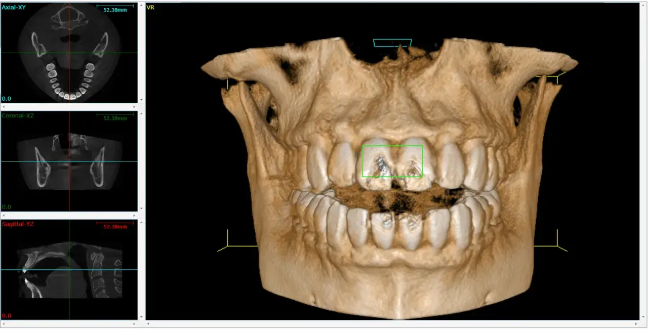 Vista 3D di denti con evidenziate aree di interesse. Si nota il canale naso palatino nelle sezioni assiale e coronale.