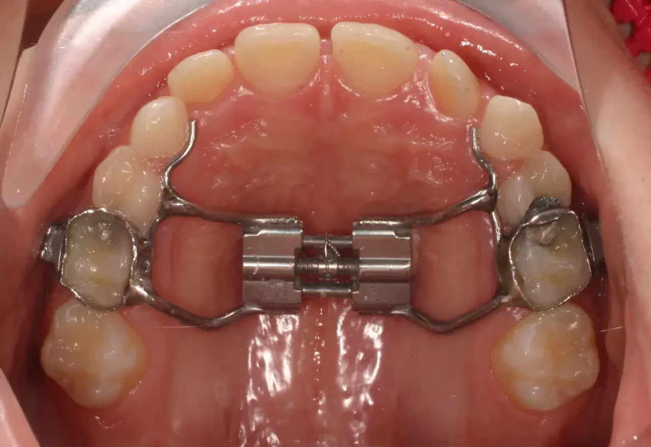 Espansore palatino con bite block ortodonzia. Strumento metallico per allargare il palato, fissato ai denti.
