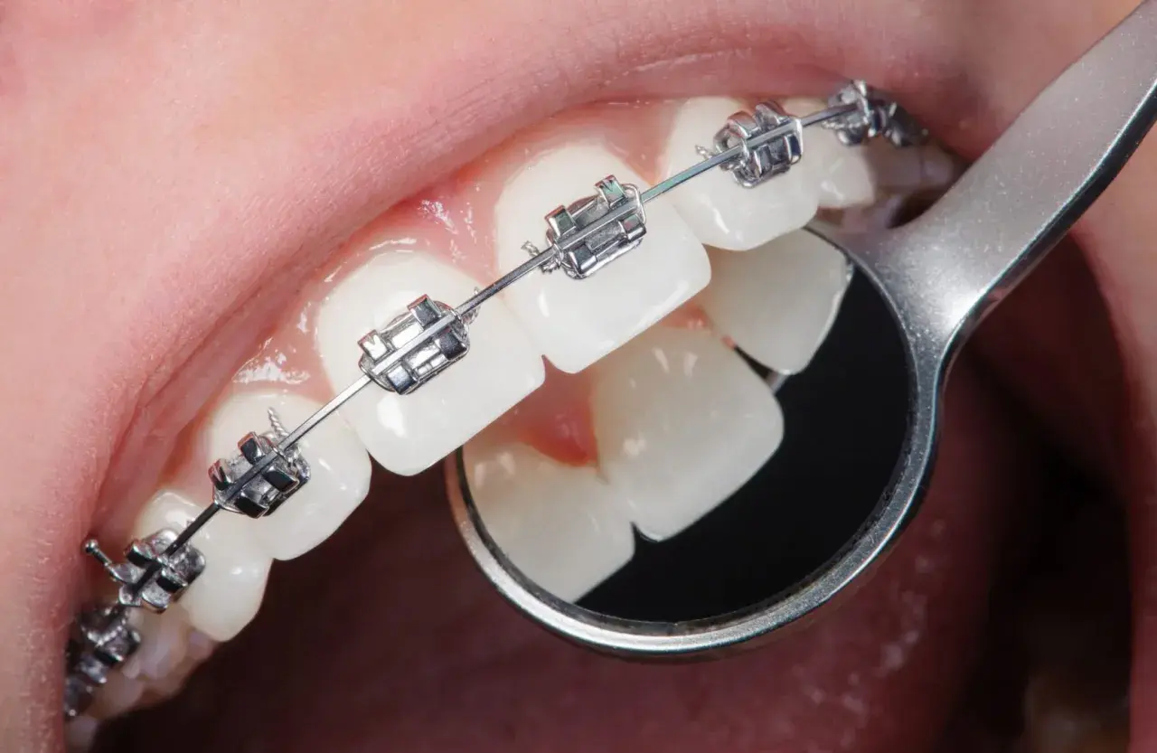 Dettaglio di denti con apparecchio ortodontico metallico. Un piccolo specchietto riflette i denti, mostrando come si mette l'apparecchio.