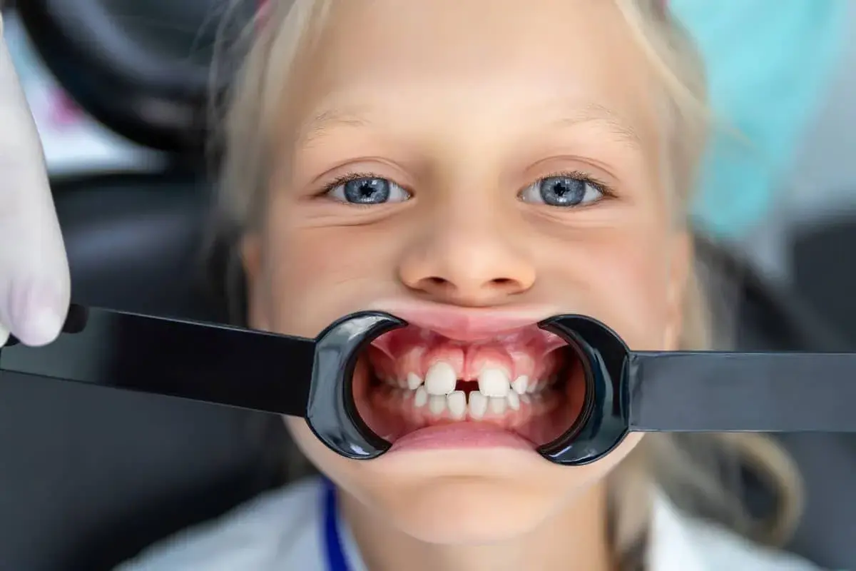Bambina con diastema, uno spazio tra i denti. Non tentare di chiudere lo spazio tra i denti fai da te, consulta un dentista.