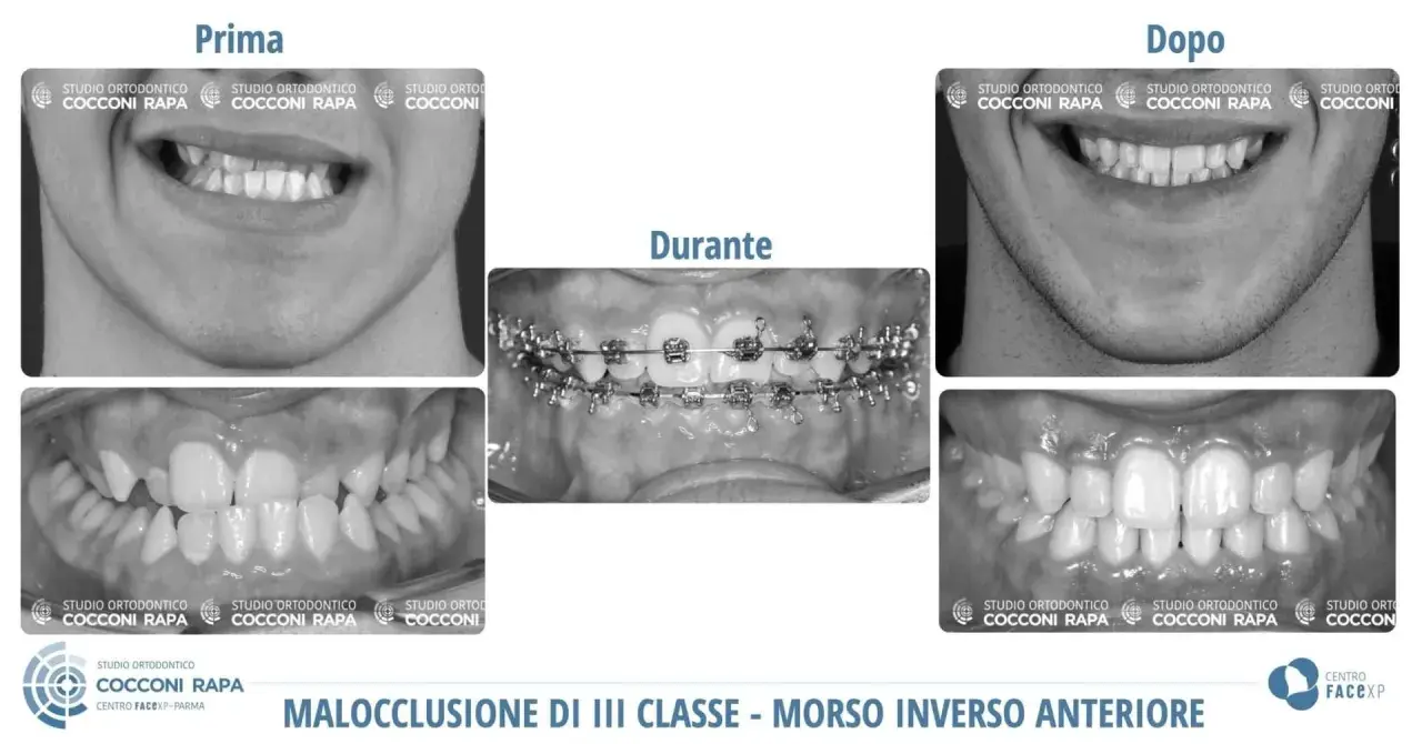 Prima e dopo un trattamento ortodontico per correggere una malocclusione dentale e problemi neurologici correlati.