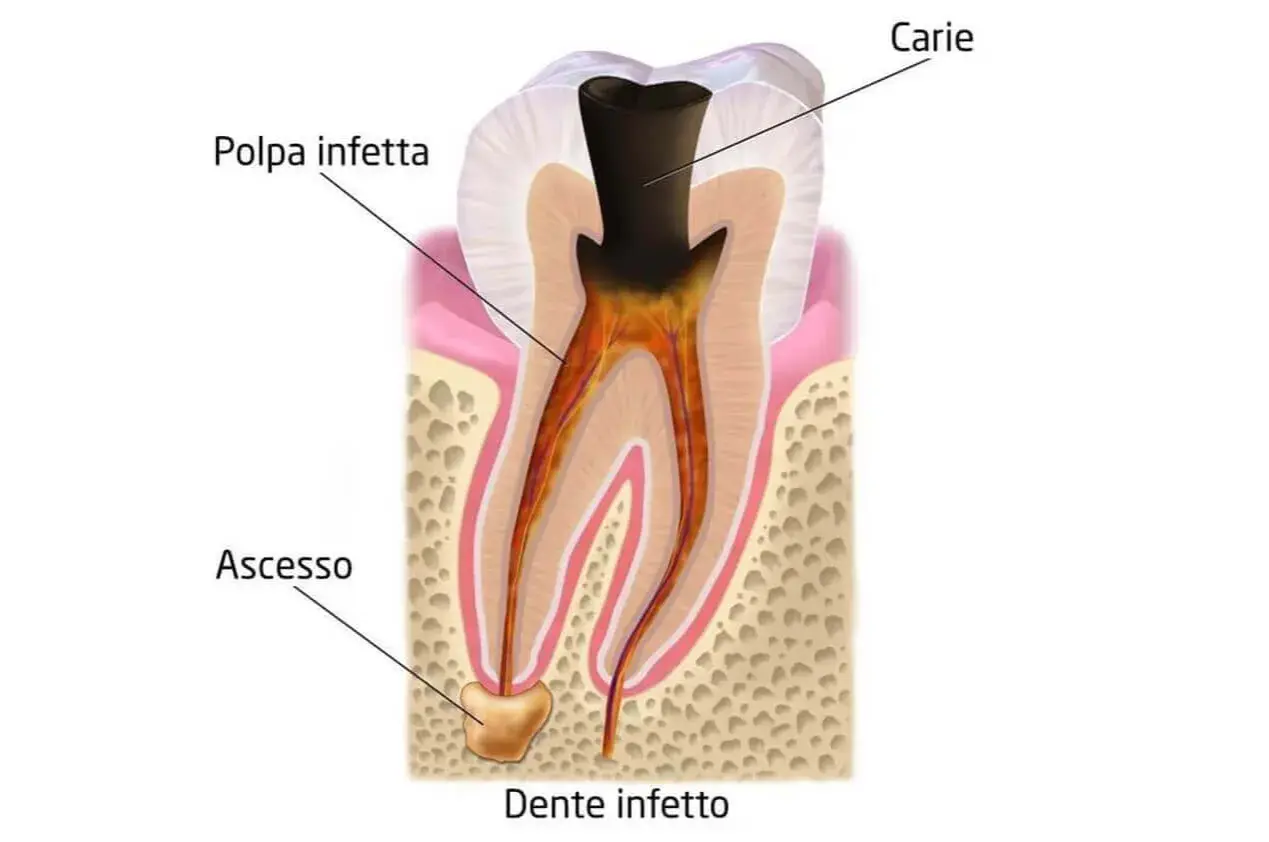 Dente infetto con carie e polpa infetta. Si nota un ascesso alla radice, segno di un'infezione avanzata.