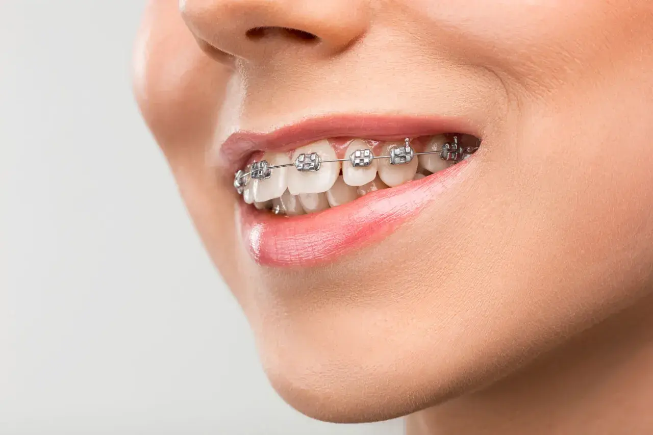 Sorriso con apparecchio ortodontico per correggere una malocclusione mandibolare. Denti allineati e labbra lucide.