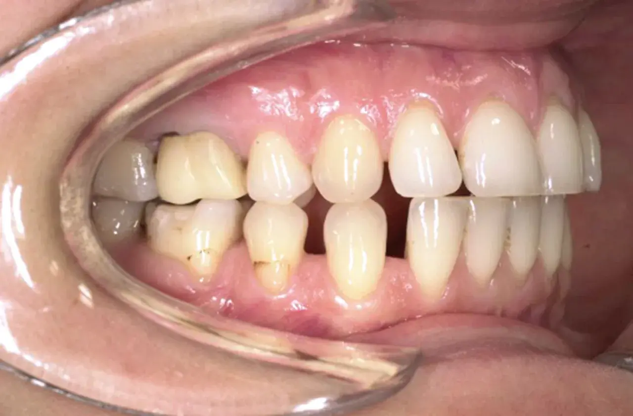 Denti con evidente overjet e overbite, alcuni incisivi superiori coprono quasi completamente quelli inferiori.