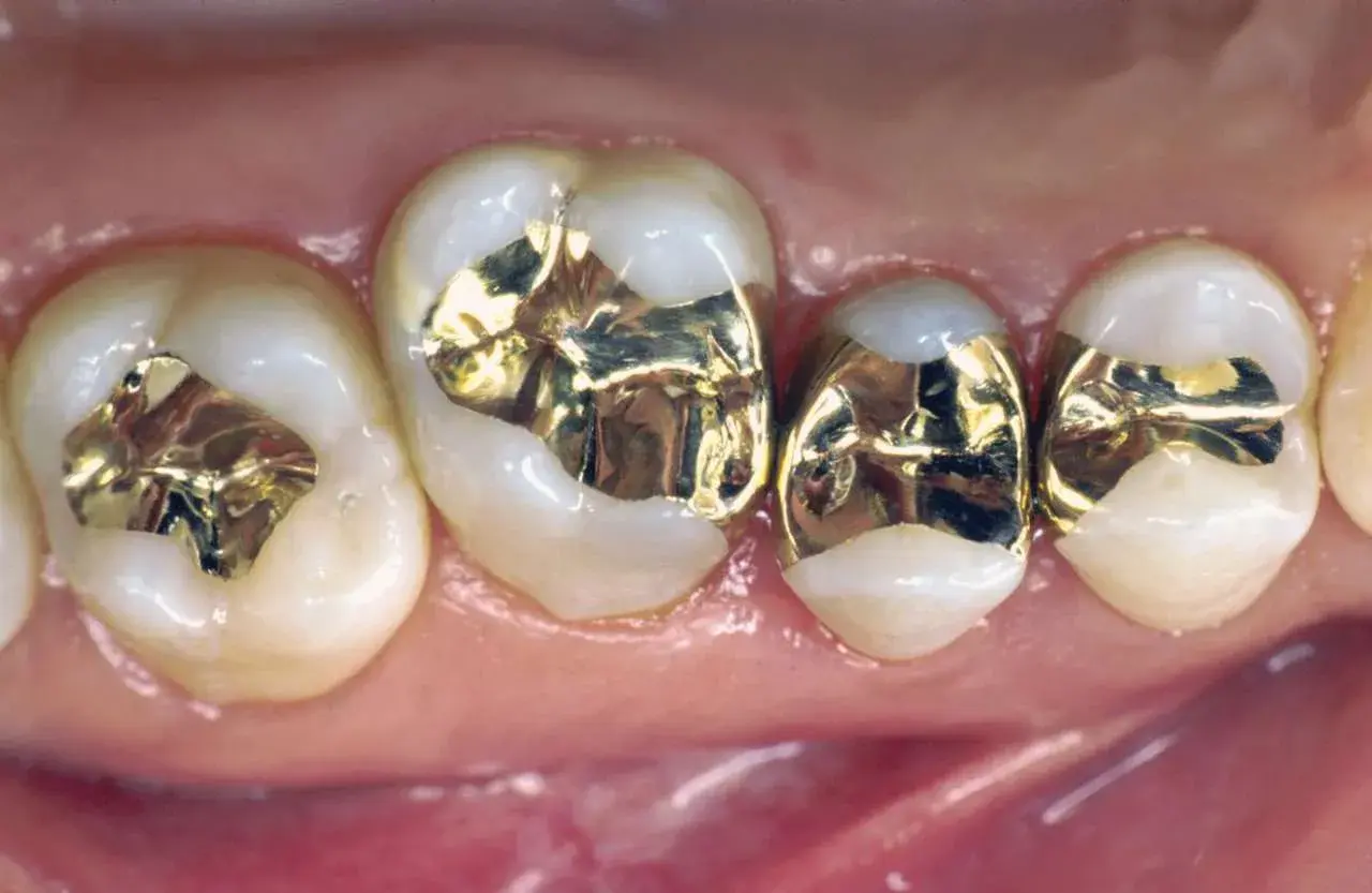 Denti con otturazioni in oro, fase di preparazione intarsio dentale.