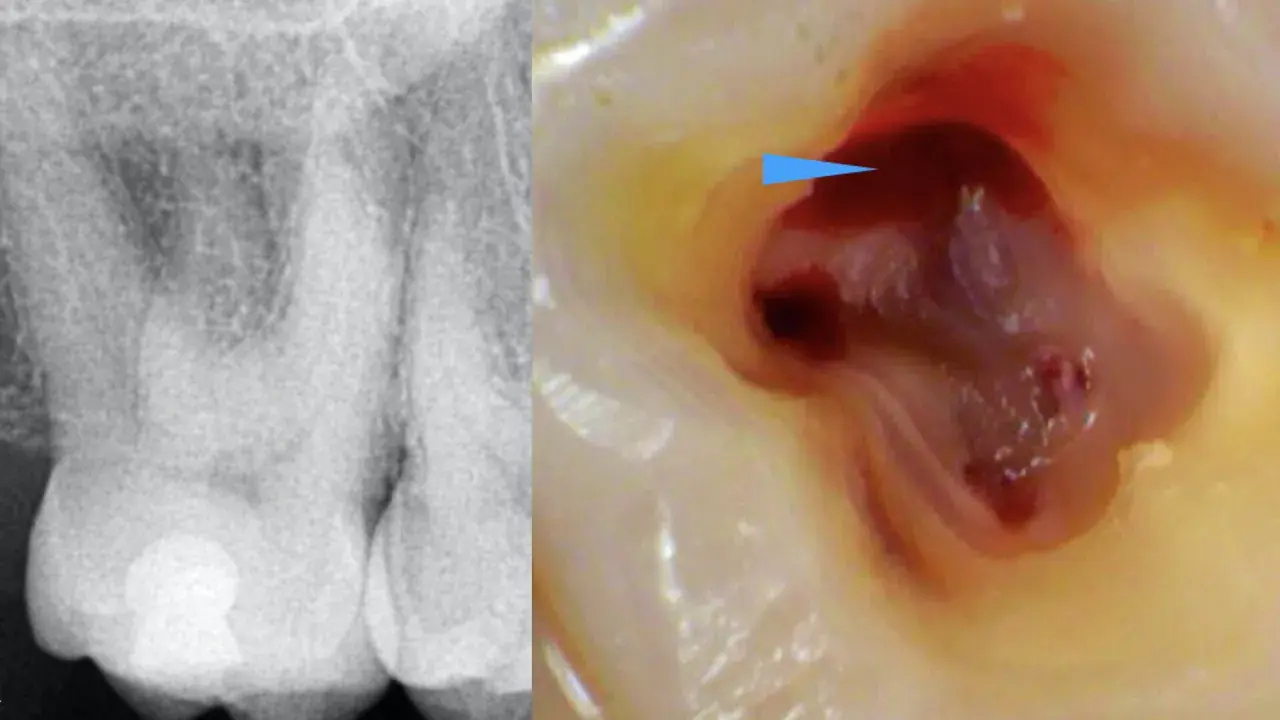 Radiografia e ingrandimento del primo molare superiore con polpa esposta e sanguinante, indicata da una freccia blu.