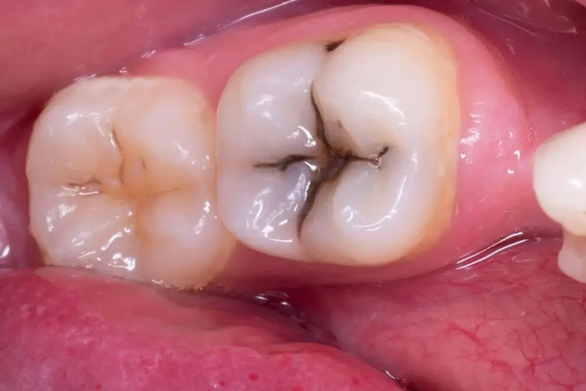 Dente con carie occlusale, un'area scura e profonda nella fessura del dente, che necessita di cure dentali.