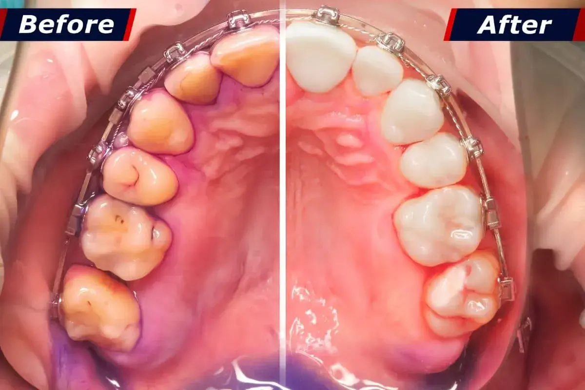 Prima e dopo: la differenza tra placca e tartaro è evidente. I denti appaiono più puliti e sani dopo il trattamento.
