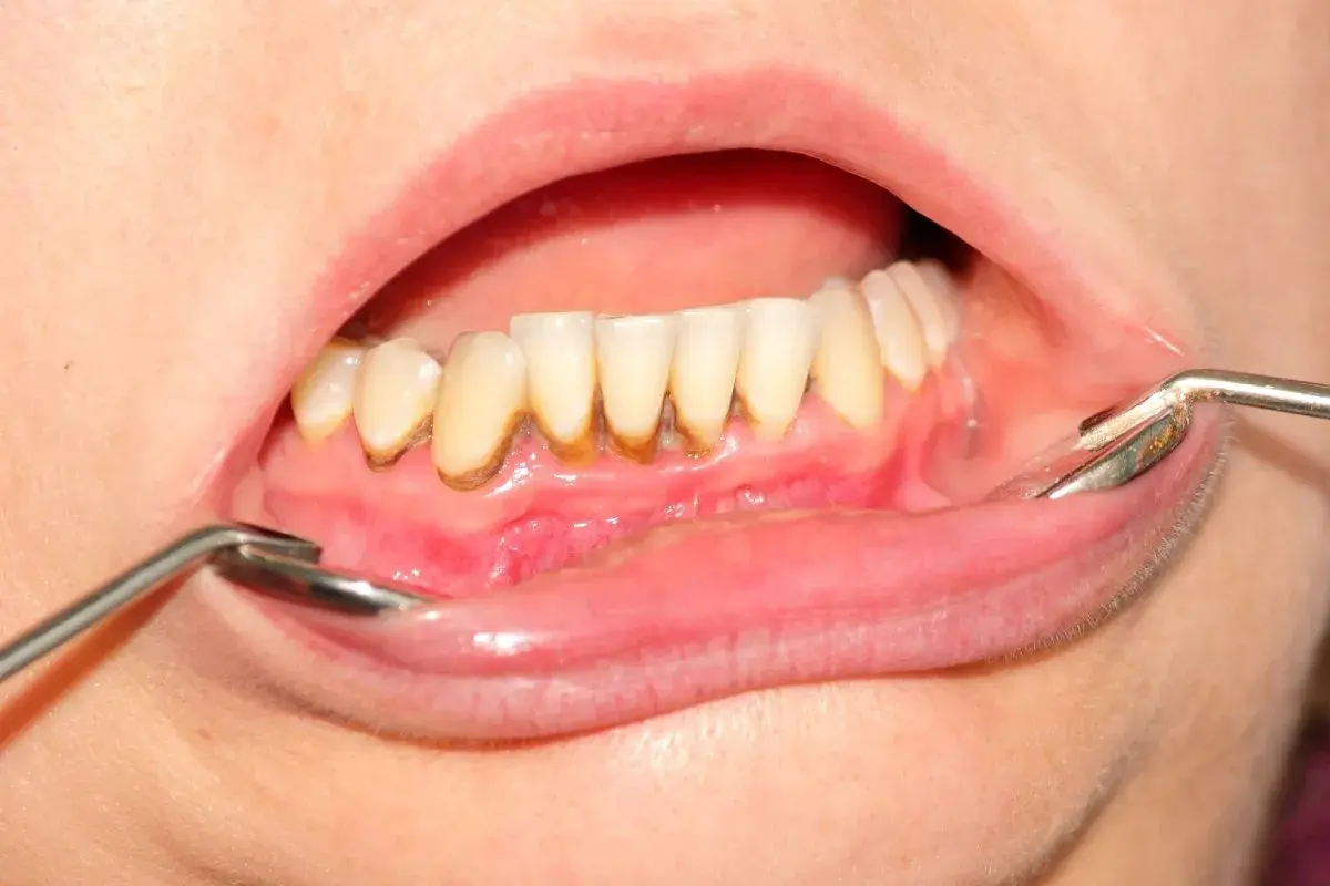 Denti con accumulo di tartaro visibile alla base, evidenziato da uno specchietto dentale.
