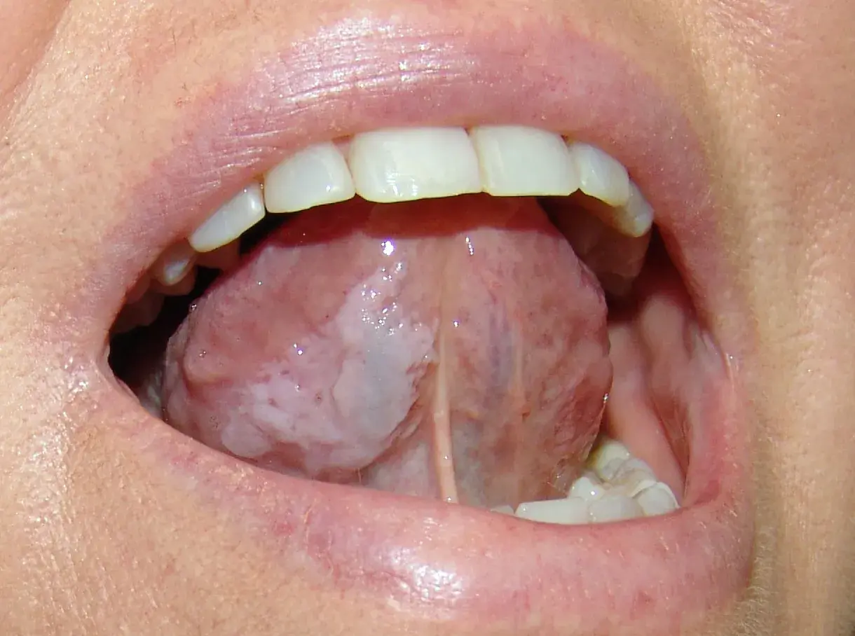 Lingua con aree bianche indicative di leucoplachia, potenziale segno precoce di tumore alla lingua.