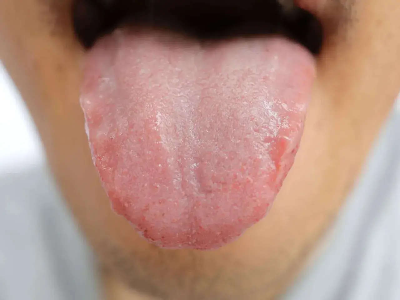 Lingua arrossata e irritata, con piccole vescicole, che suggeriscono un bruciore alla lingua.