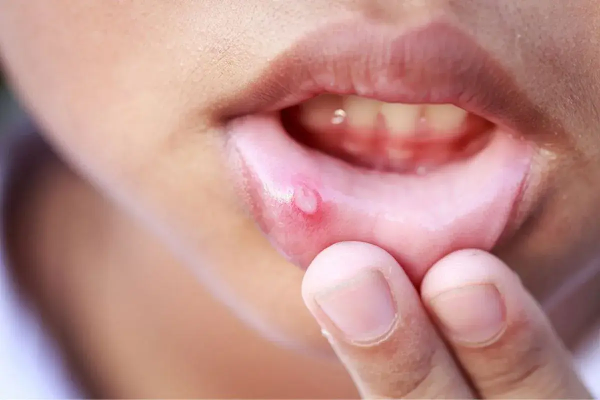 Una piccola vescicola infiammata sulla mucosa orale, vicino alle labbra, evidenziata da un dito.