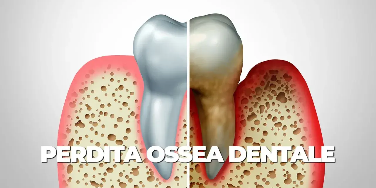 Illustrazione di un dente sano e uno malato, con osso alveolare che mostra riassorbimento osseo alveolare diffuso di tipo orizzontale e verticale.