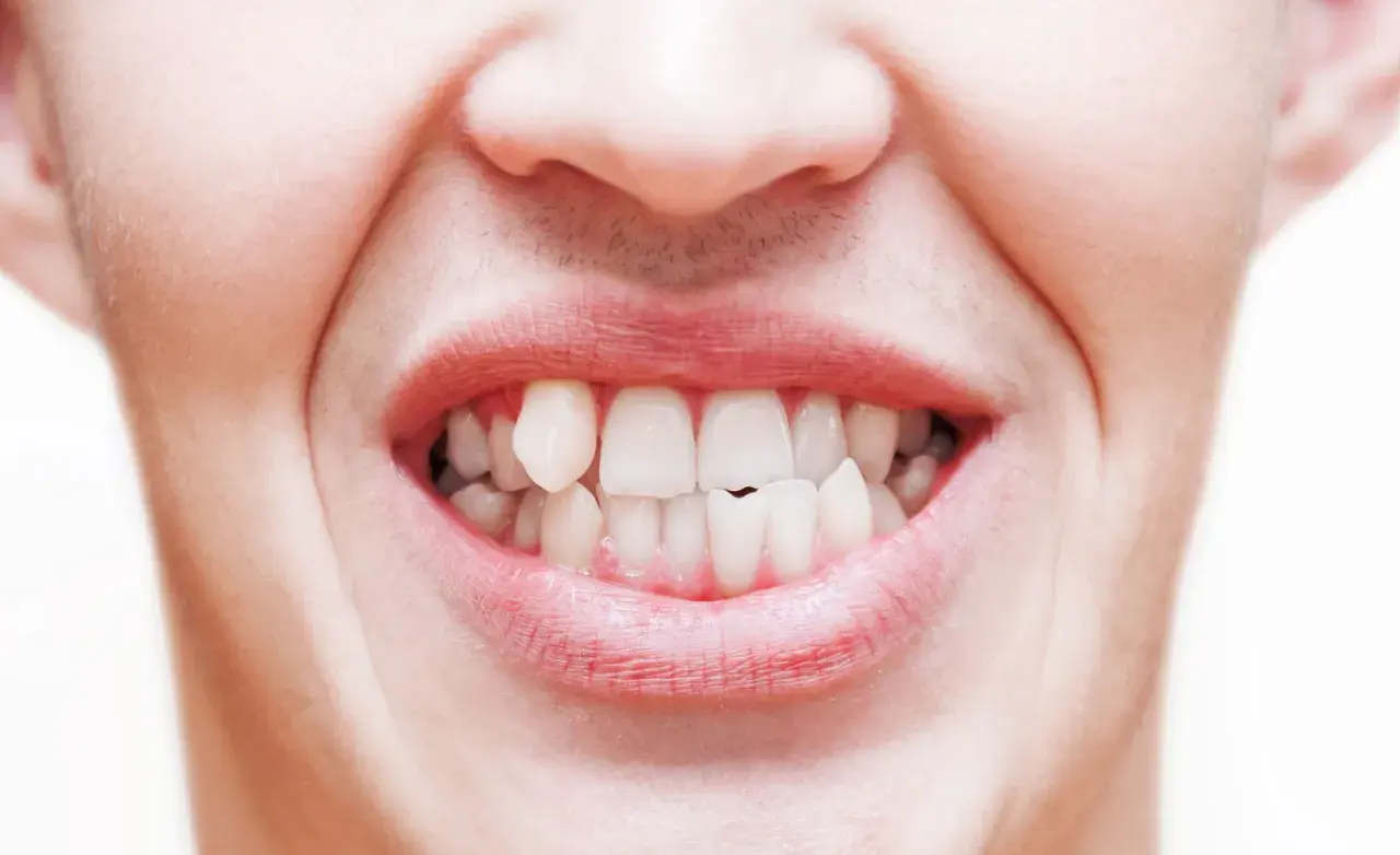 Primo piano di una bocca con labbra arrossate e denti bianchi, alcuni leggermente storti, che sembrano battere per il freddo o la tensione.