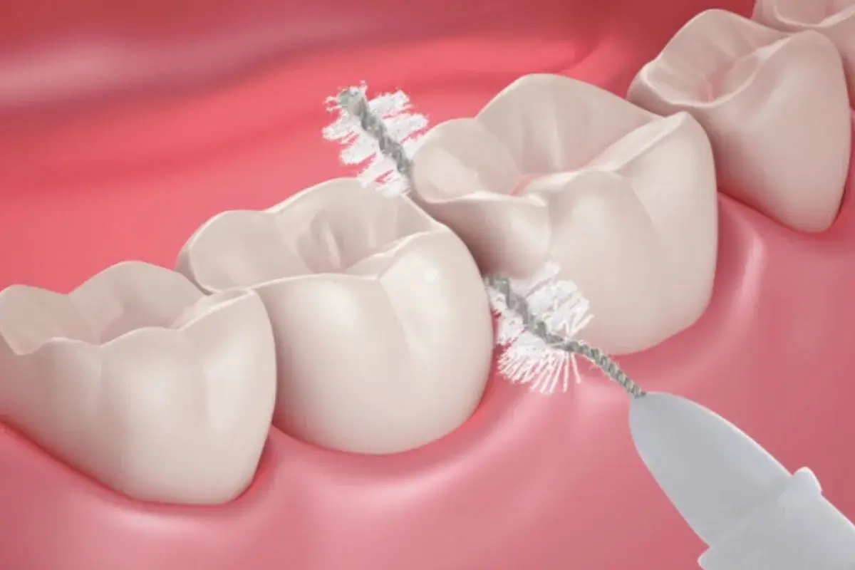 Un piccolo scovolino pulisce con cura gli spazi tra i denti, un'alternativa efficace al filo interdentale per un sorriso smagliante.