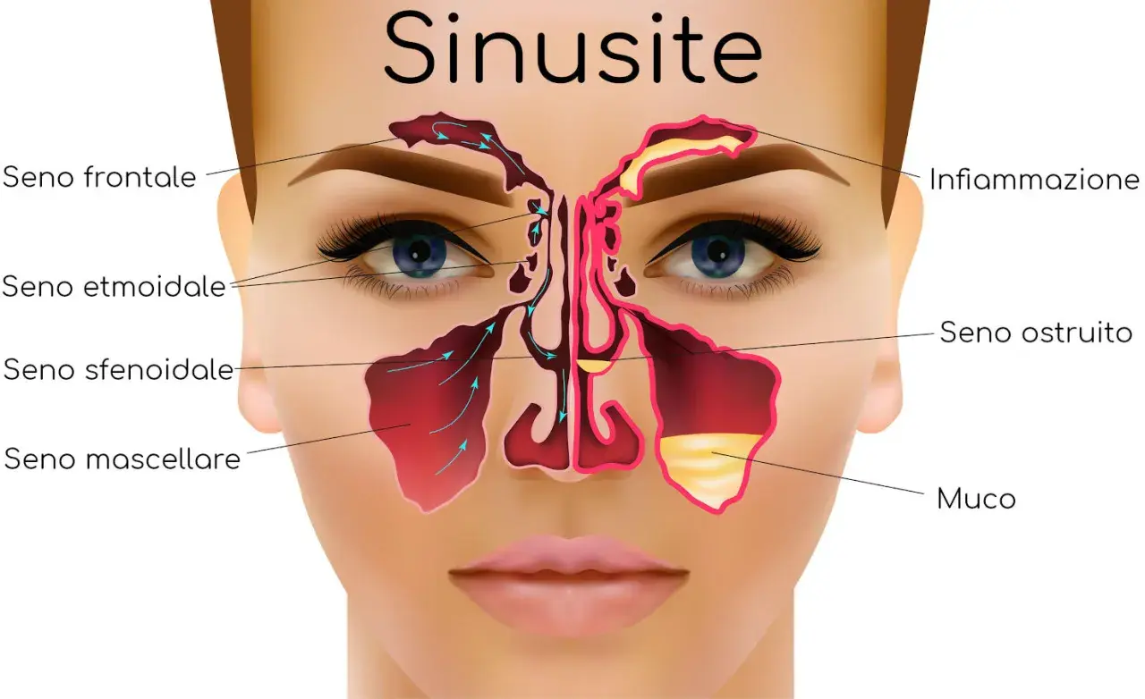 Illustrazione anatomica della sinusite, con enfasi sulla sinusopatia mascellare, mostrando infiammazione e accumulo di muco nei seni paranasali.
