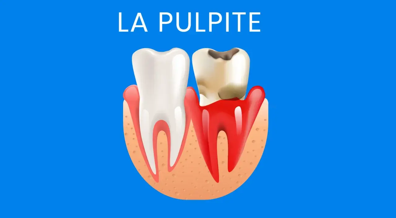 Dente sano a sinistra, dente cariato e infiammato a destra, con la scritta "LA PULPITE" in alto.