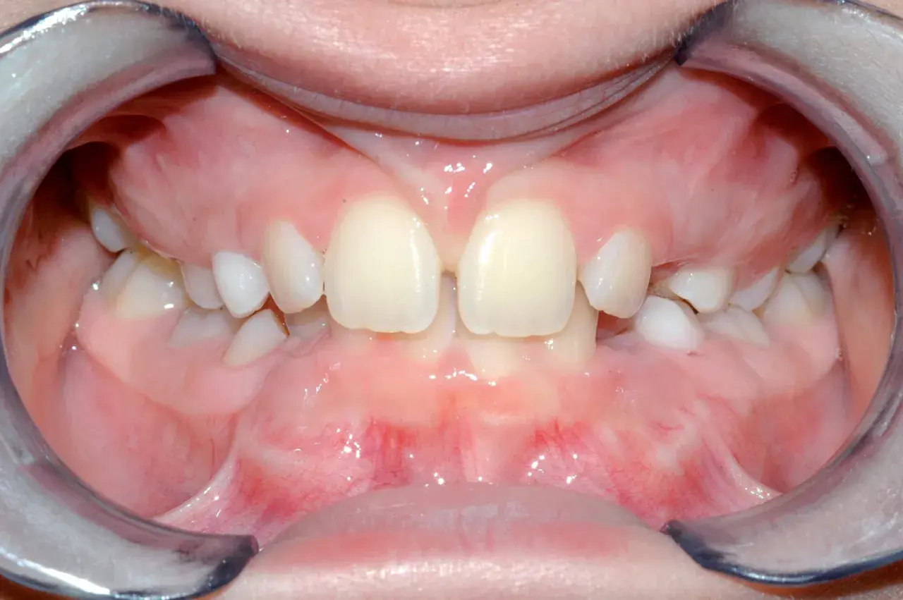 Bocca aperta con denti da latte e il frenulo labiale superiore visibile tra gli incisivi centrali.
