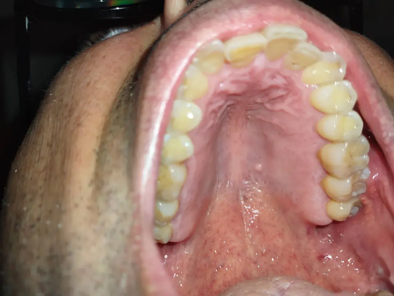 Vista ravvicinata della bocca con denti ingialliti e una piccola cisti sul palato.