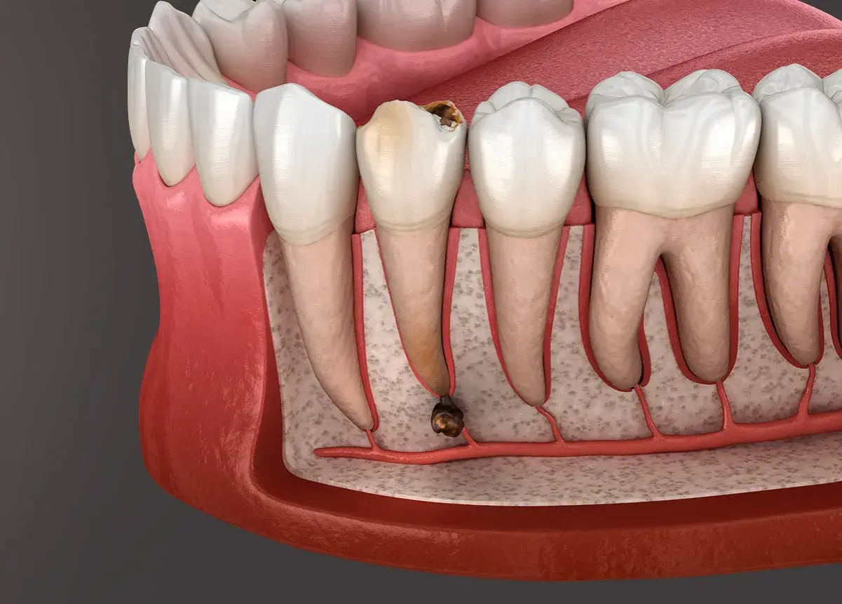 Dente cariato con radice infetta, pronto per l'estrazione. La durata estrazione dente dipende dalla complessità.