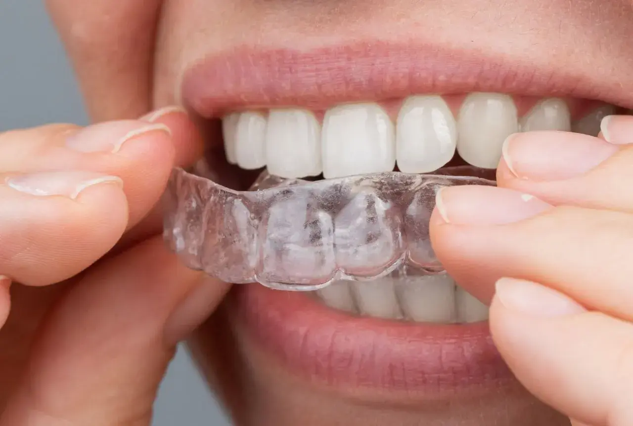 Dita che posizionano un apparecchio invisibile sui denti bianchi.