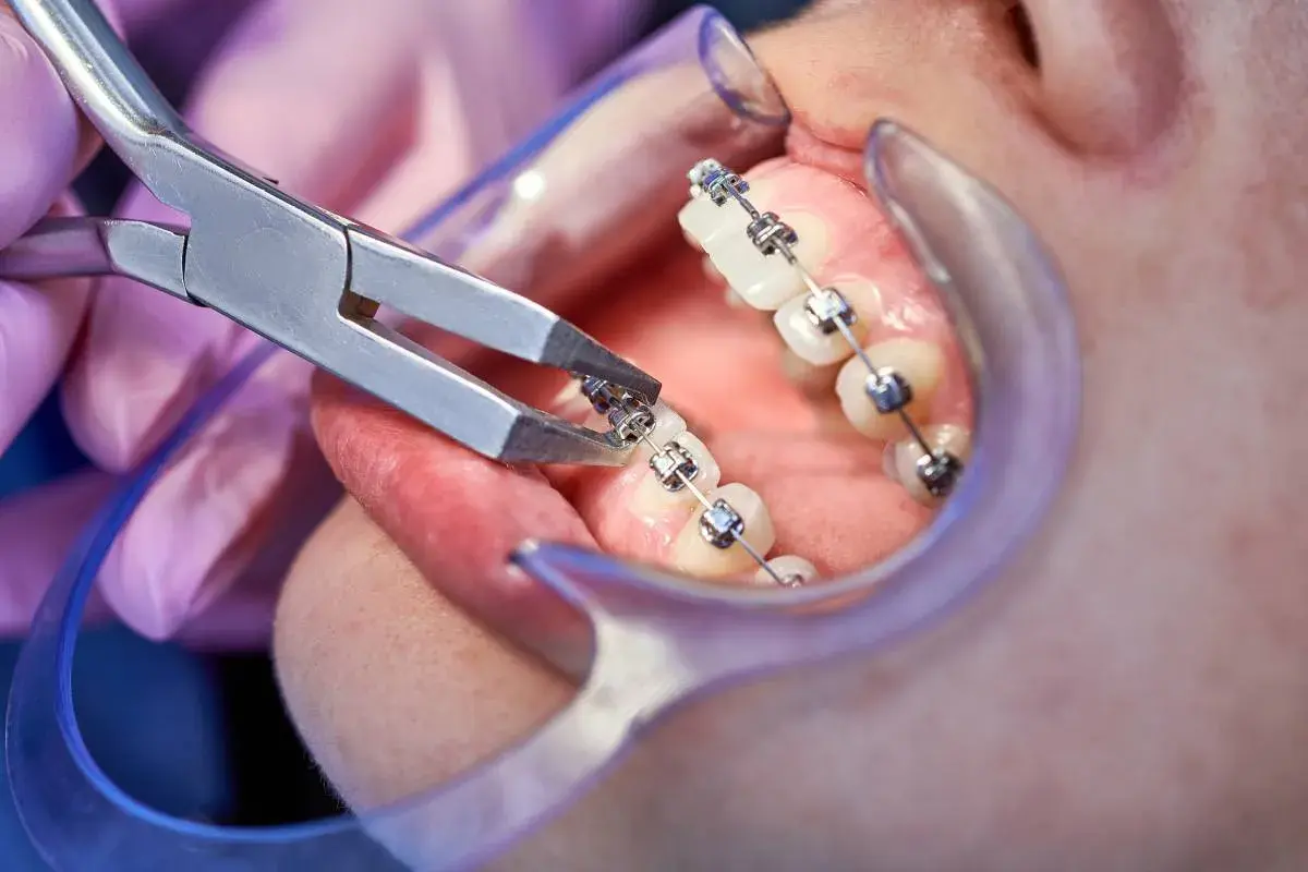 Un dentista usa pinze per sistemare i brackets ortodontici su un dente.