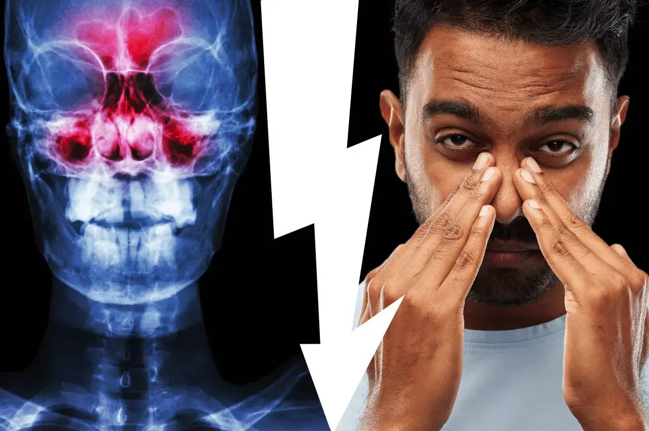Radiografia dei seni paranasali con infiammazione e uomo che si tocca il naso, suggerendo un problema di sinusite odontogena e la necessità di un intervento.