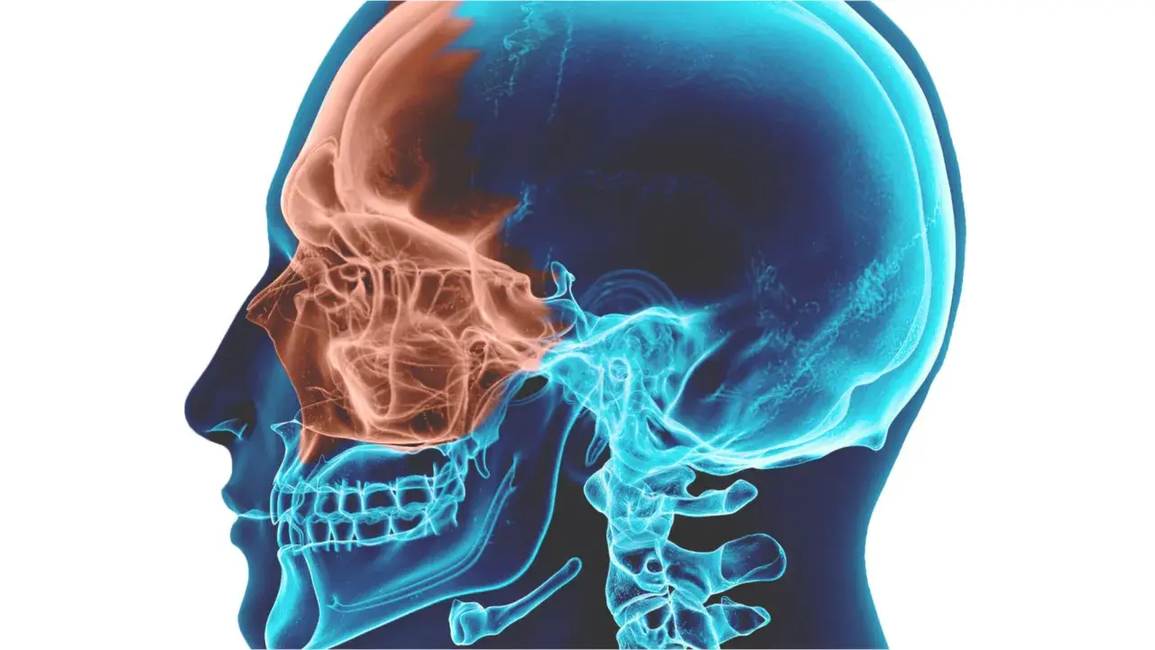Anatomia del cranio in sezione, evidenziando i seni mascellari in arancione. Utile per comprendere la sinusite mascellare odontogena e i suoi rimedi.