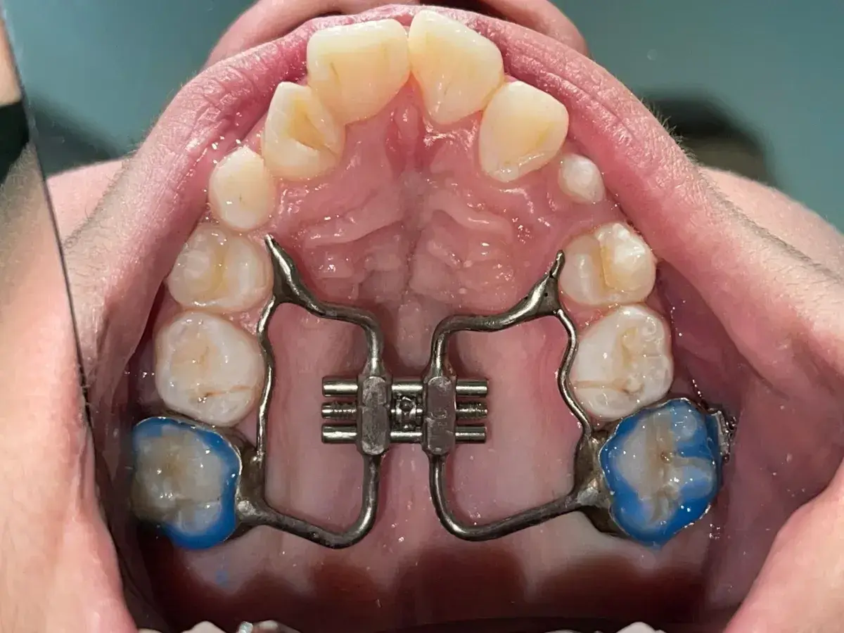Espansore palato bambini costo: apparecchio ortodontico per allargare il palato, con placchette blu sui molari.