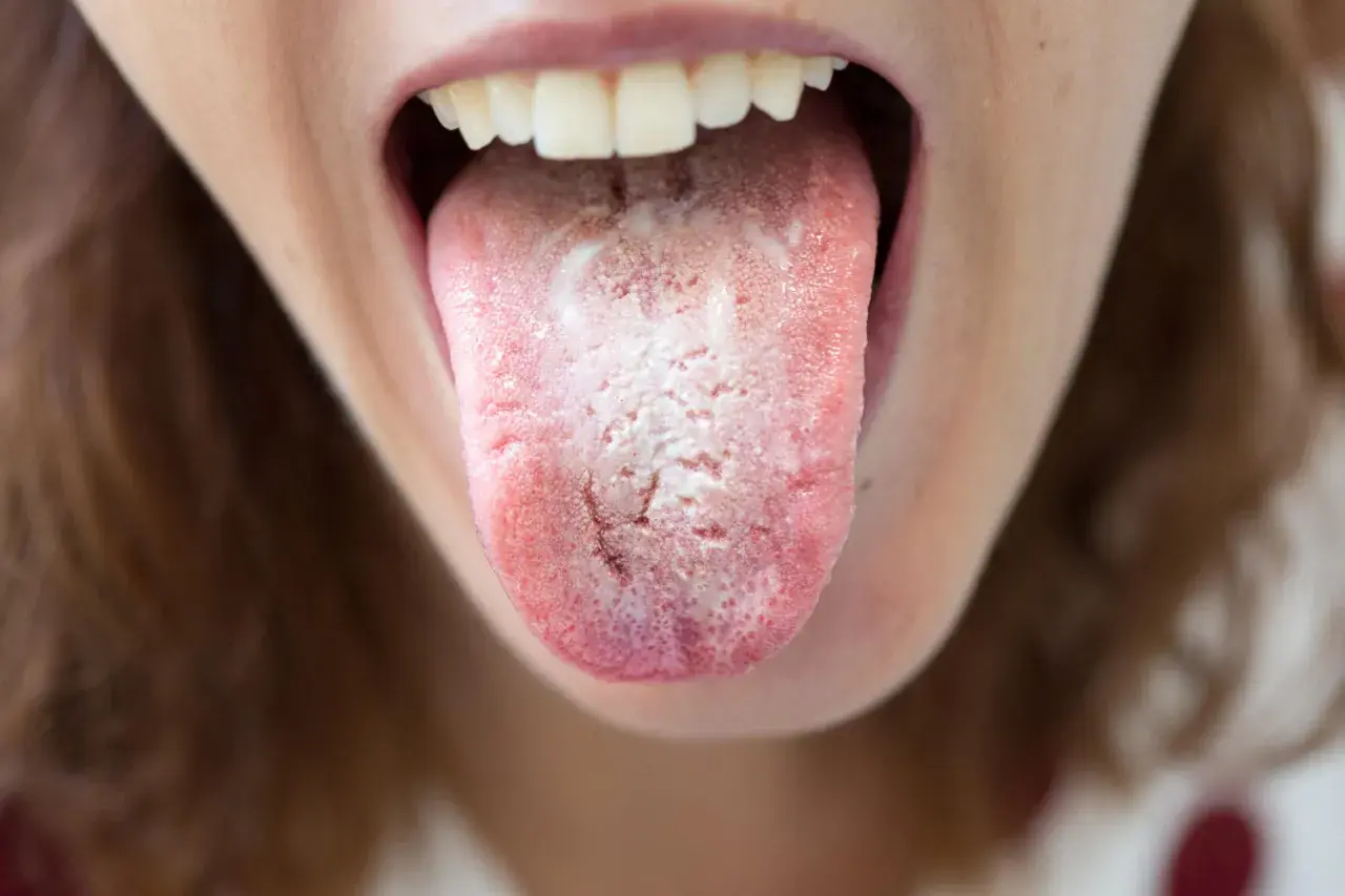 Lingua con patina bianca e rossore, segno di un'infezione da candida che si spera passi da sola.
