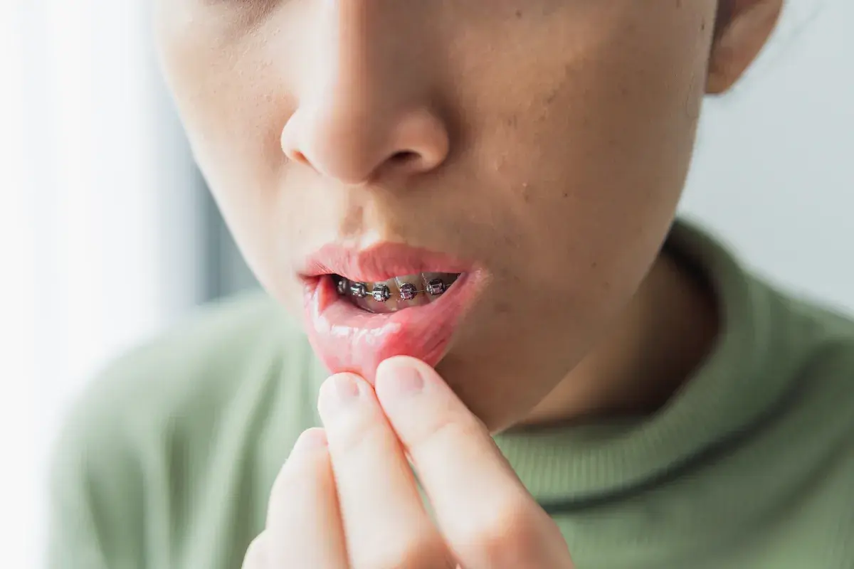 Bocca con apparecchio ortodontico, labbro inferiore irritato e con piccole piaghe da apparecchio ortodontico.