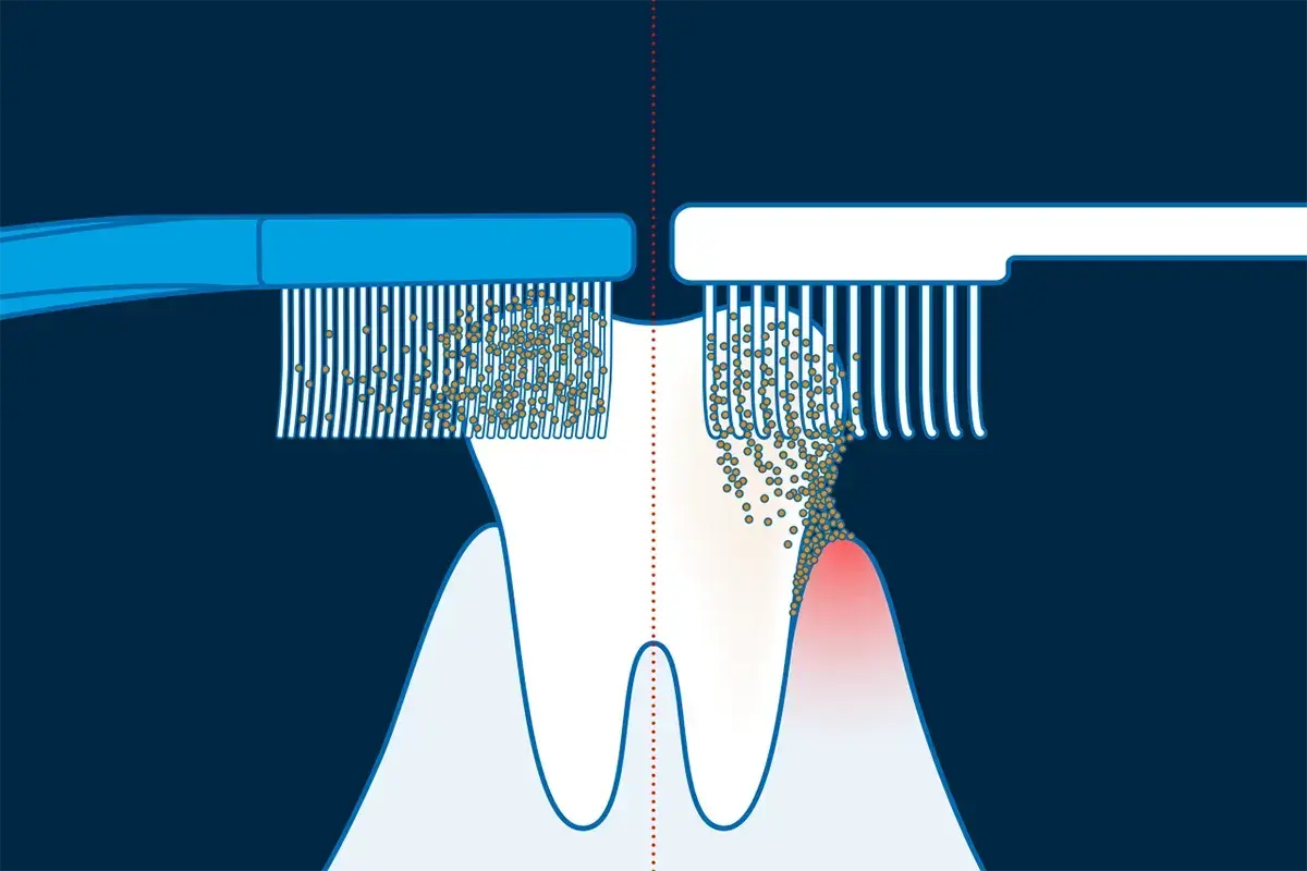Illustrazione della tecnica di Bass: spazzolino a sinistra pulisce bene, a destra mostra accumulo di placca e gengiva infiammata.