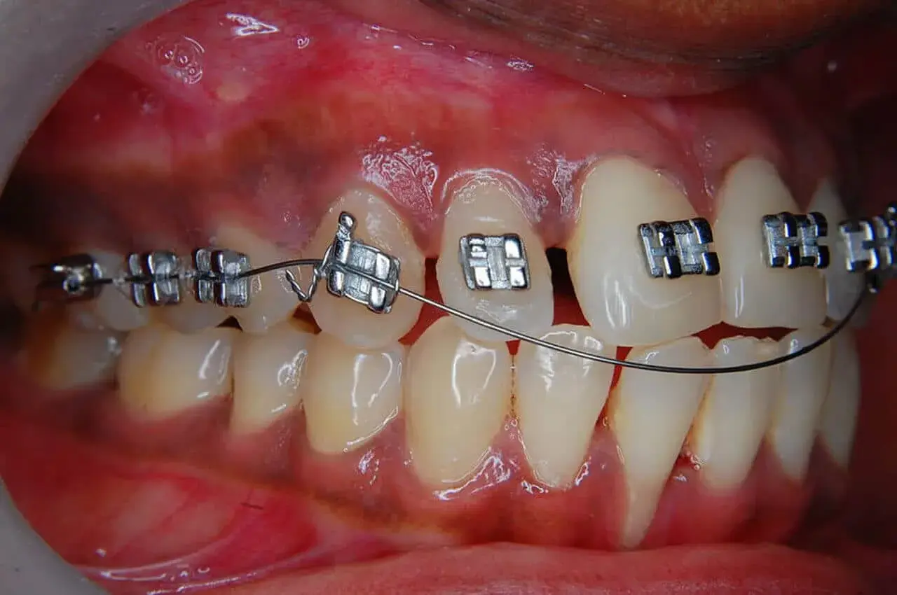 Primo piano di denti con apparecchio fisso. Impossibile togliere l'apparecchio fisso da soli.