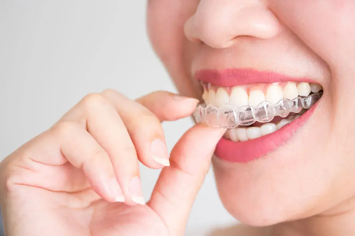 Dettaglio di una bocca con un apparecchio estetico trasparente, che corregge i denti per un sorriso perfetto.
