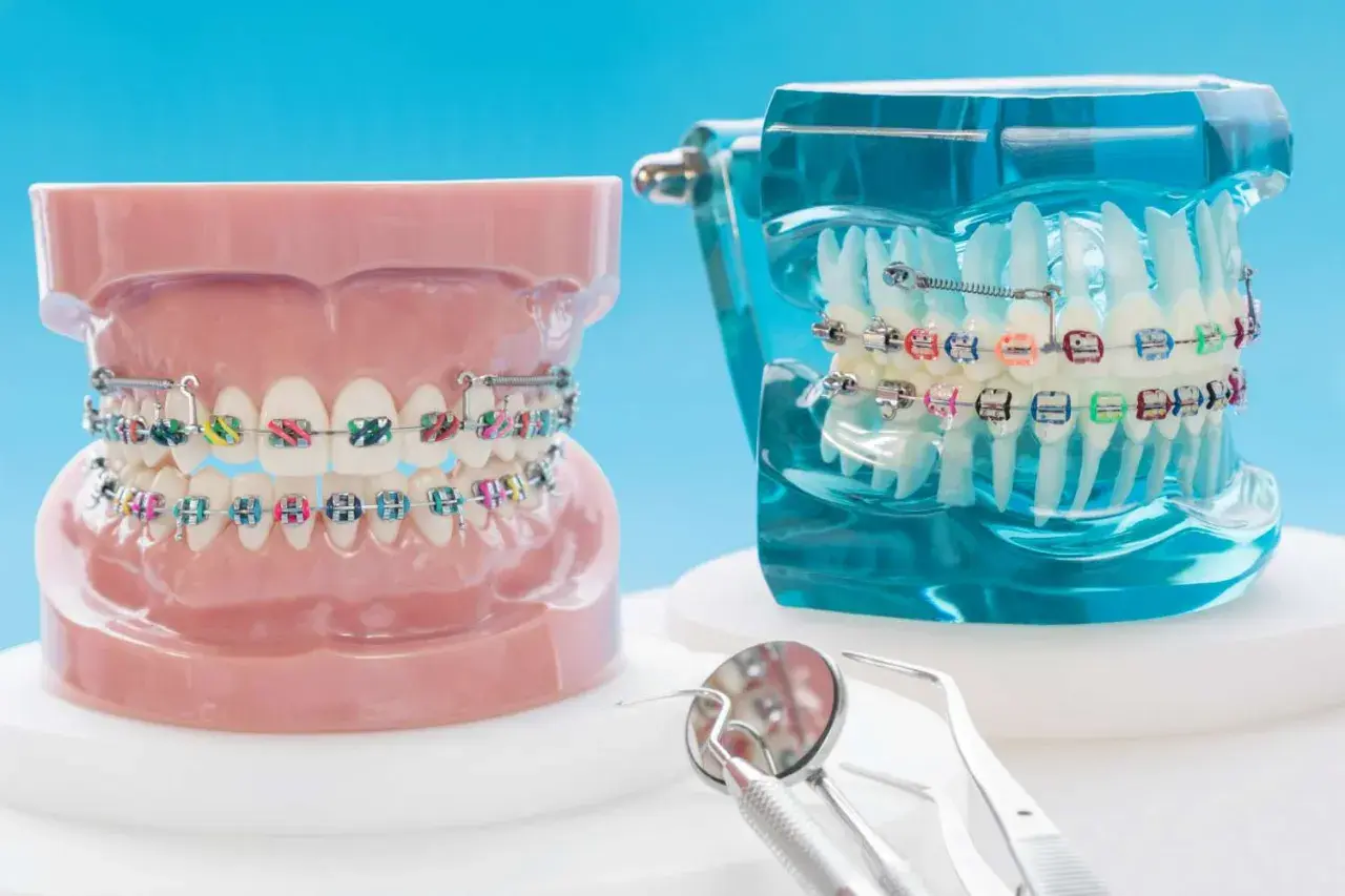 Modelli di denti con apparecchi ortodontici e elastici colorati. Strumenti dentistici in primo piano.
