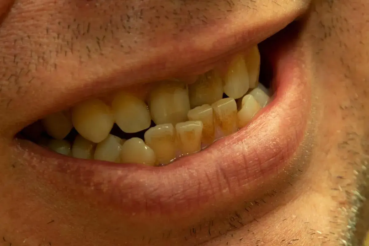 Primo piano di una bocca con denti ingialliti e disallineati, indicativi di una malocclusione di terza classe.
