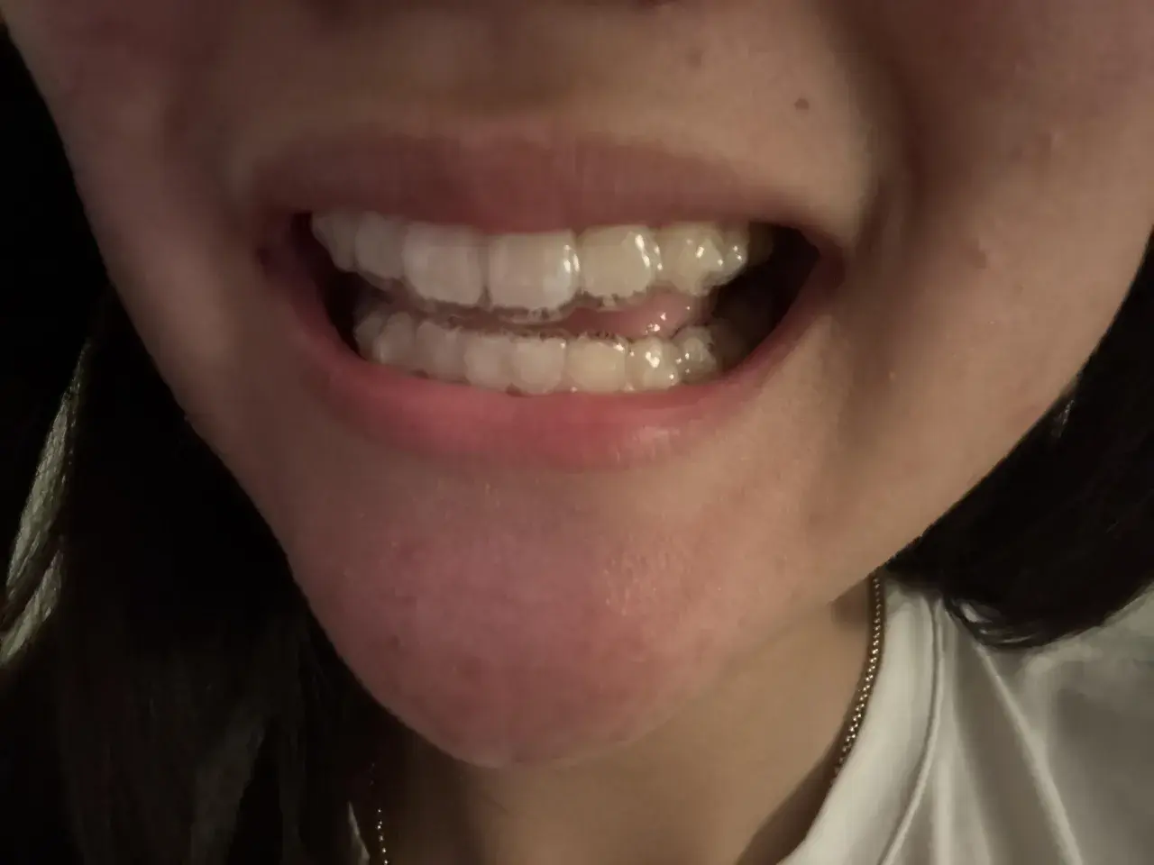 Primo piano di una bocca con apparecchi invisibili e chewies Invisalign per un sorriso perfetto.
