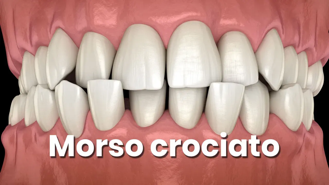Denti con morso incrociato, una condizione che necessita di correzione ortodontica.