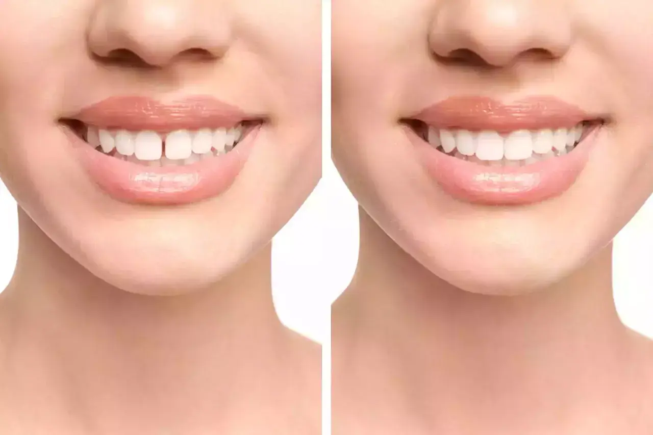Prima e dopo: il diastema, uno spazio tra i denti, viene corretto per un sorriso perfetto.