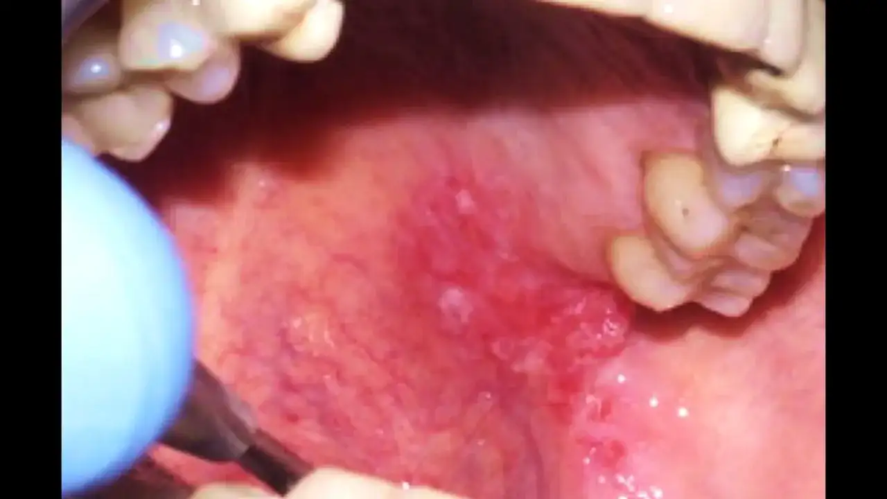 Lingua infiammata con lesioni, strumento medico vicino. La biopsia lingua è dolorosa.