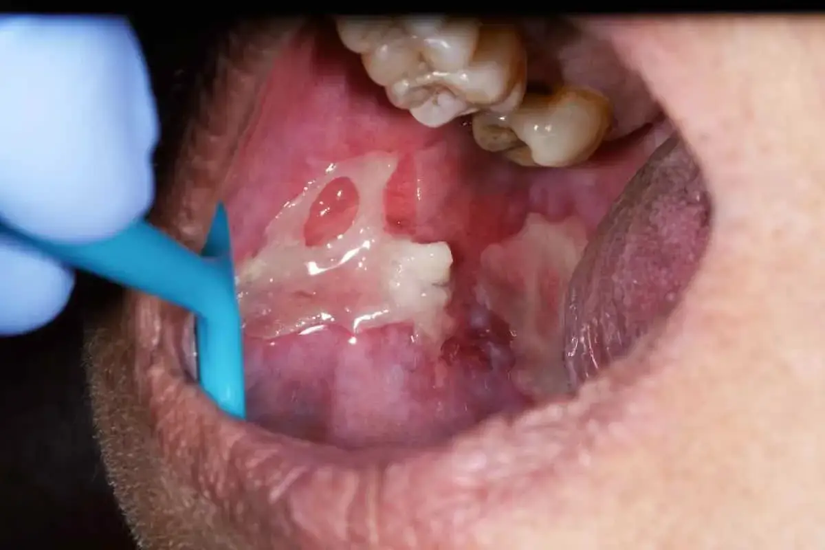 Esame di una lesione mucosa geniena con un abbassalingua blu. Si notano ulcere e aree biancastre.