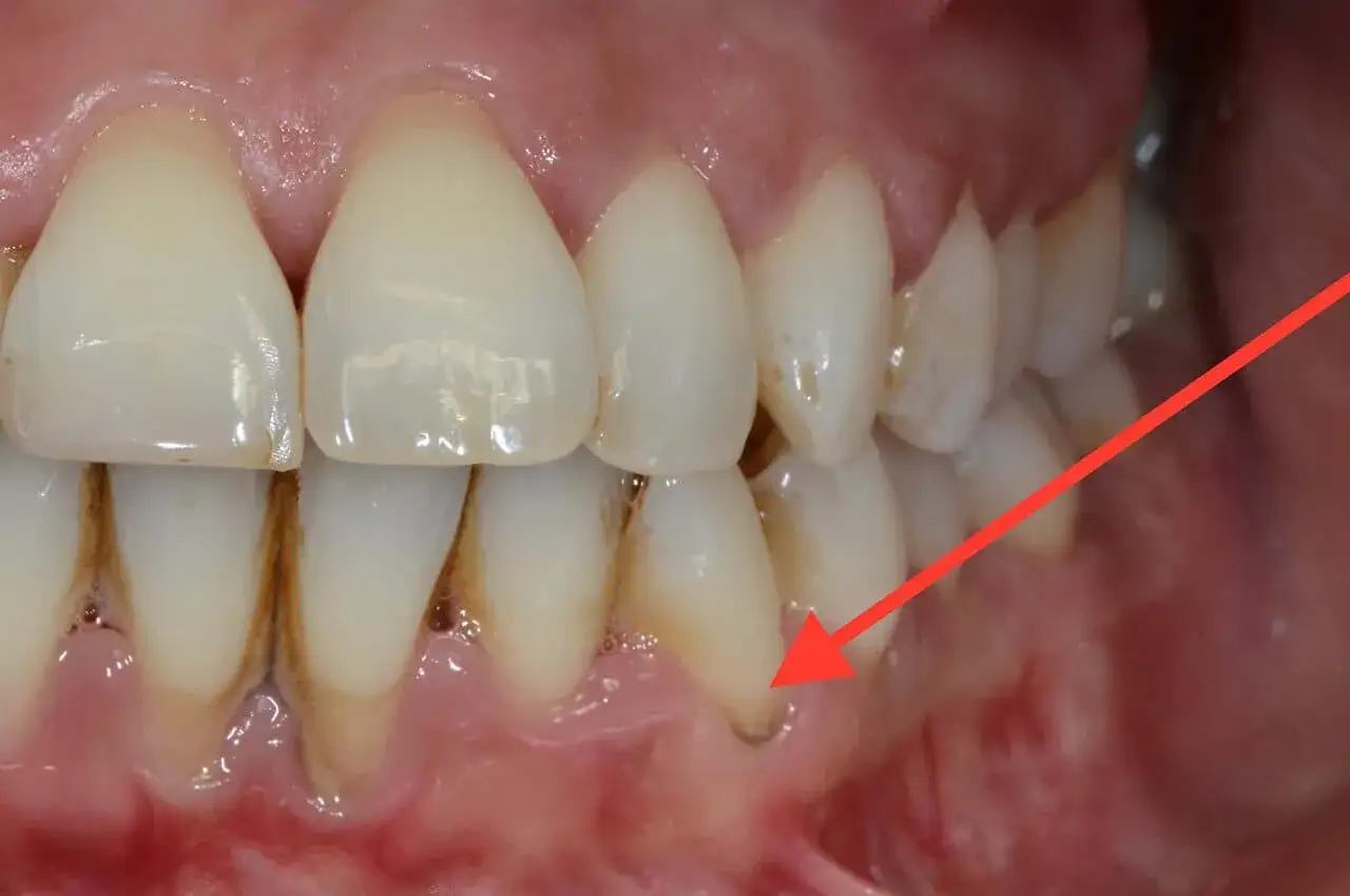 Denti con tartaro visibile alla base, un segnale che il tartaro fa cadere i denti. Gengive infiammate.