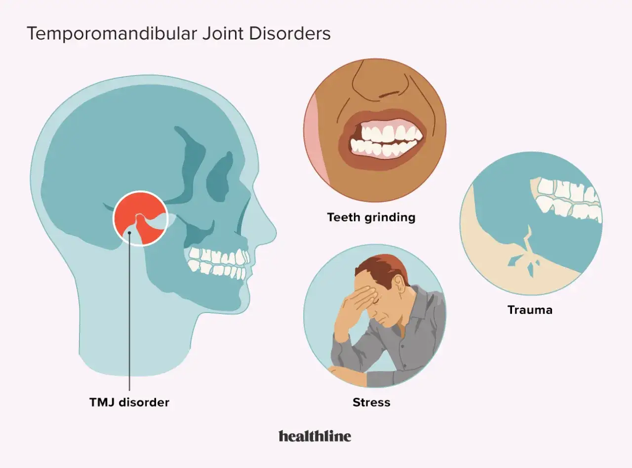 Illustrazione che mostra la mascella e i sintomi dell'infiammazione temporo-mandibolare: digrignamento denti, stress, trauma.