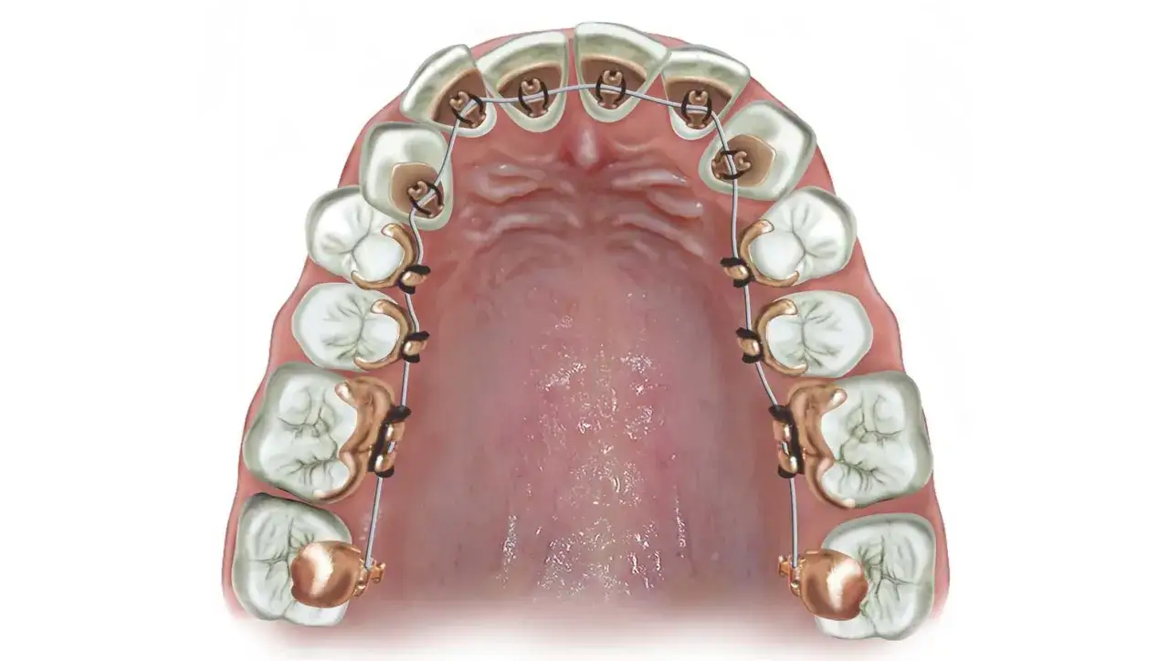 Dettaglio di un apparecchio linguale, con brackets dorati e filo metallico applicati sulla superficie interna dei denti per correggere l'allineamento.